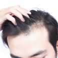 If you think your hairline is receding every time you look in the mirror, you’re not alone. More than half of men 51 or older have signs of hair loss. […]