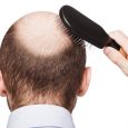A common skin condition, alopecia areata usually starts as a single quarter-sized circle of perfectly smooth bald skin. These patches usually regrow in three to six months without treatment. Sometimes, […]