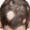 Androgenetic alopecia (commonly called male or female pattern baldness) is the most common form of hair loss. This occurs in men whose hair follicles are sensitive to the hormone dihydrotestosterone, […]