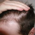 By the age of 50, 30 to 50 percent of men will be affected by male-pattern hair loss to one degree or another. This figure continues to grow as you […]