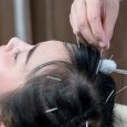 There are many alternative treatments that hair loss sufferers may consider, but perhaps one of the most underrated is acupuncture. In this guide to acupuncture for hair loss, you’re going […]
