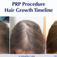 If you are a woman suffering from temple recession or overall female pattern baldness, a treatment for thinning hair may be very much on your mind. You may have heard […]