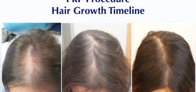 If you are a woman suffering from temple recession or overall female pattern baldness, a treatment for thinning hair may be very much on your mind. You may have heard […]