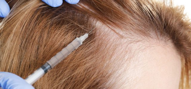 Platelet-rich plasma (PRP) therapy is a successful treatment for various dermatologic conditions, including male and female pattern hair loss as well as scars. Those are the findings from a so-called […]