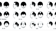 The Hamilton-Norwood Scale, better known simply as the Norwood Scale, is a way of measuring and categorizing male pattern baldness using an illustrated representation of the progression of hair loss […]