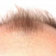 If you are seeking out information about the early signs of balding, it’s very likely that you believe you are experiencing the beginning stages of male pattern baldness (MPB) yourself. There are […]