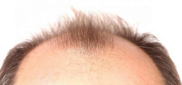 If you are seeking out information about the early signs of balding, it’s very likely that you believe you are experiencing the beginning stages of male pattern baldness (MPB) yourself. There are […]