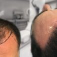 For those who are experiencing hair loss, the promise of restoring hair loss is very exciting, especially being able to get a natural, thick hairline. One of the biggest concerns […]