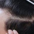 Whether you notice white flakes in your hair or on your shoulders, few hair-related issues are as much of an annoyance as dandruff. Dandruff is the result of a dry […]